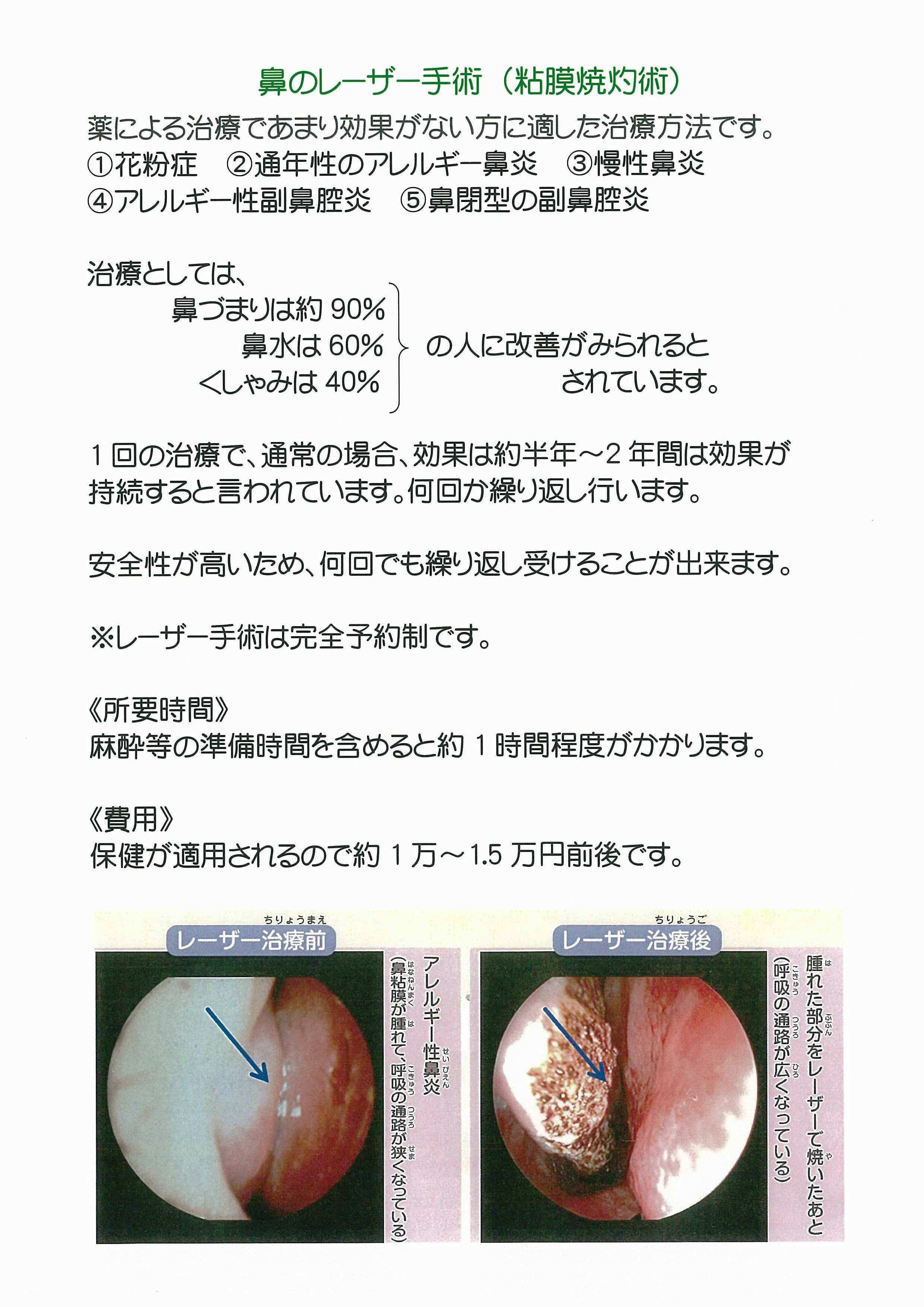 鼻 の 粘膜 焼く