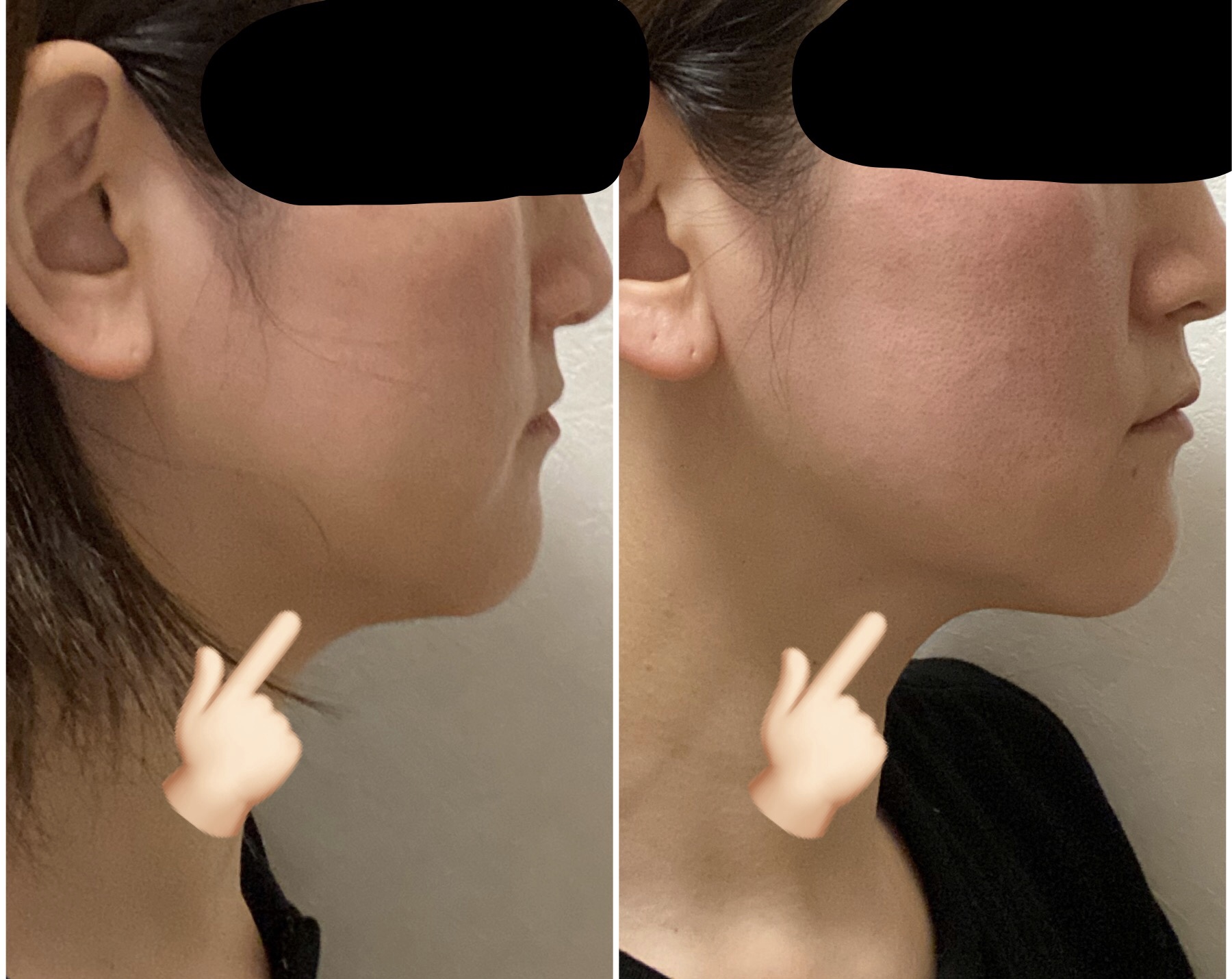 pXNjbN@HIFU@before@after@1