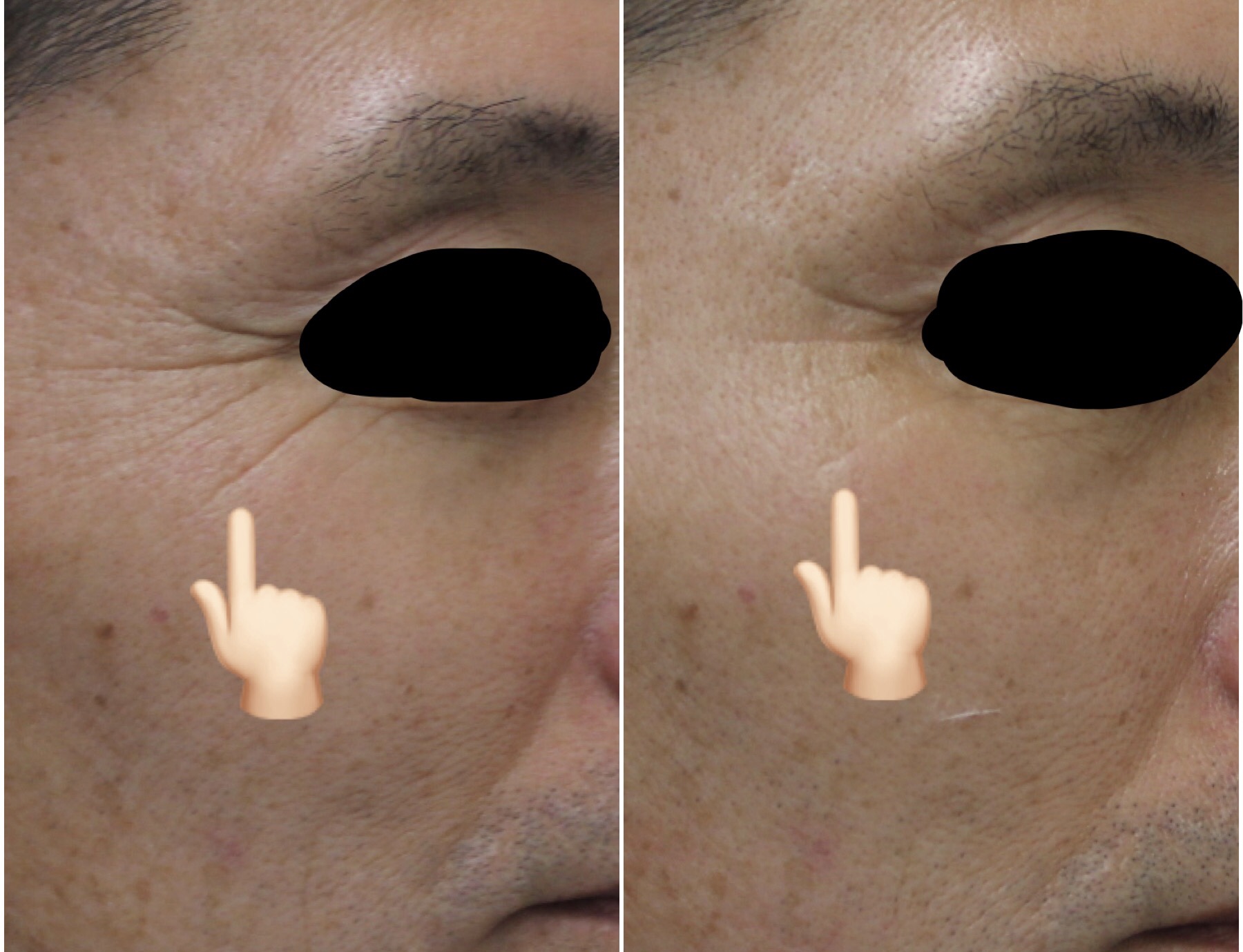 pXNjbN@HIFU@before@after