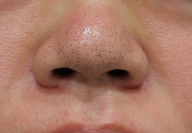 治療 鼻 の 毛穴 【2022年最新】いちご鼻・毛穴の黒ずみ治療におすすめの美容皮膚科・クリニックTOP10！
