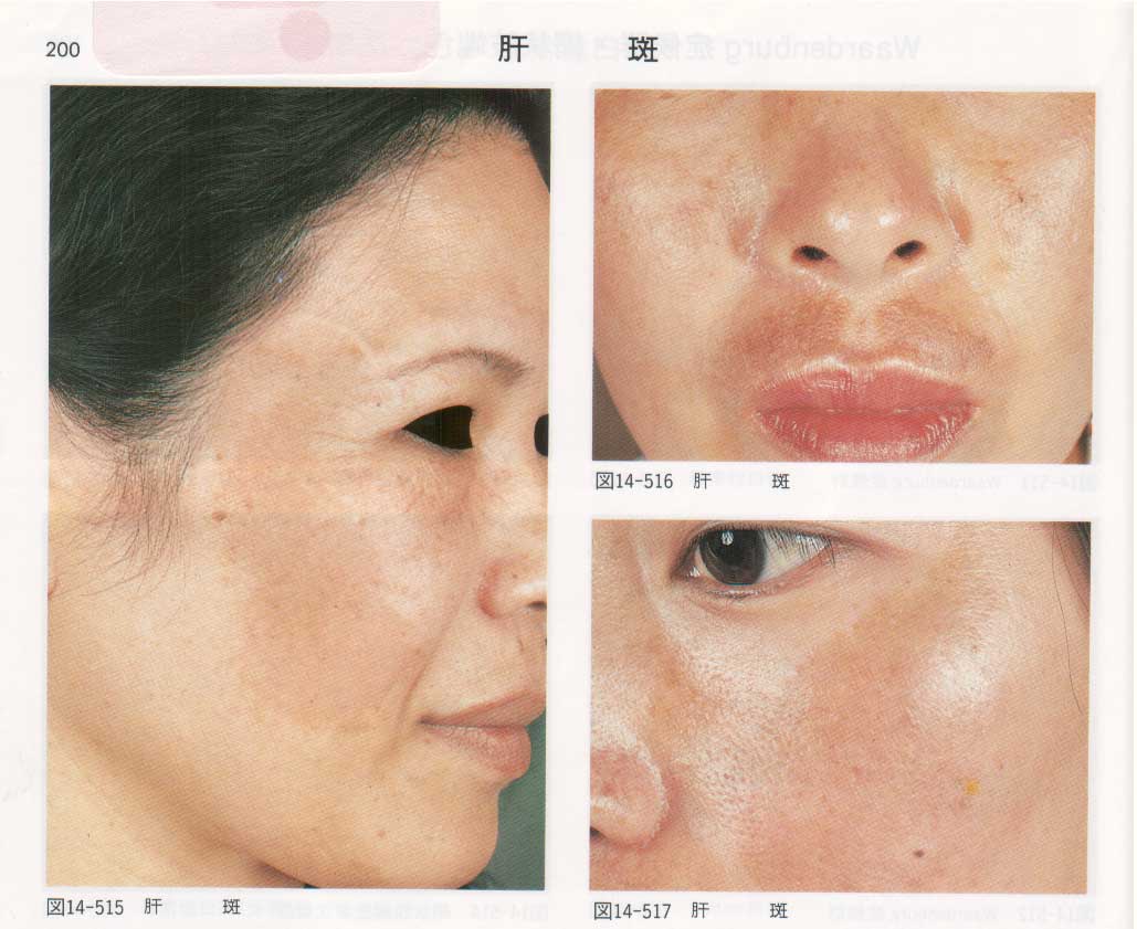 肝斑 | 横浜の美容皮膚科 美容外科 アンジュール横浜クリニック | Page 3