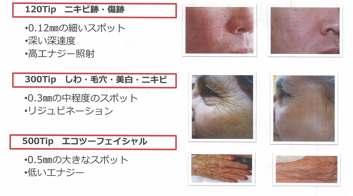 エコツー Eco2 エボリューション フラクショナルレーザー パレスクリニック