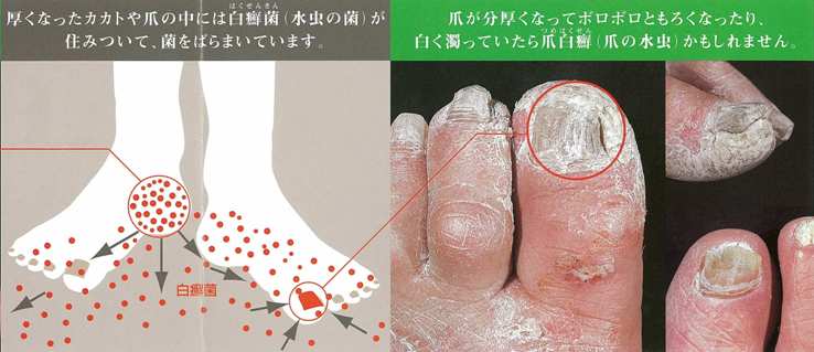 爪 白癬 菌 白癬菌が爪に感染するには１０年必要！？爪水虫になる条件